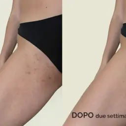 Prima e dopo due settimane: come depilare l'inguine con la lametta per una pelle liscia e senza irritazioni.