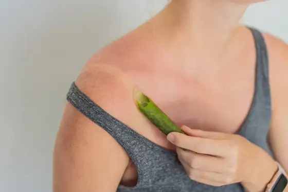 Aloe vera dopo il sole - benefici, uso ed errori da evitare