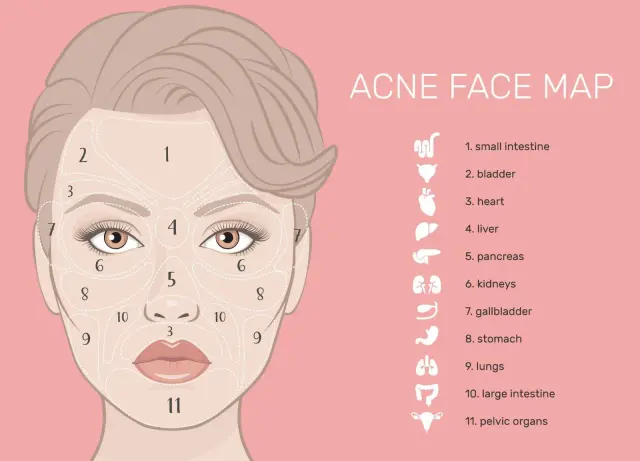 Mappa del viso per l'acne: la zona 3, intorno alla bocca, è collegata agli organi pelvici.